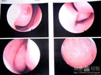 鼻炎患者才可以完全的康復？