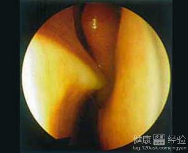 鼻中隔偏曲矯正手術後恢復注意事項