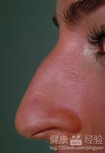 得了過敏性鼻炎如何治療？