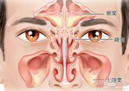 鼻窦炎症怎麼形成的