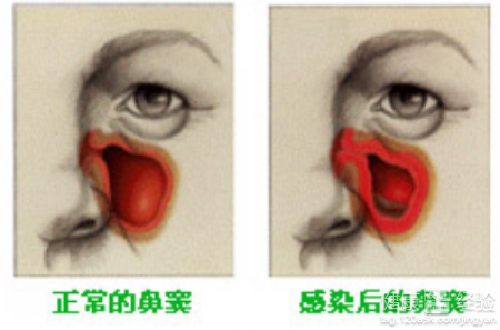 哪些症狀的鼻窦炎算嚴重嗎