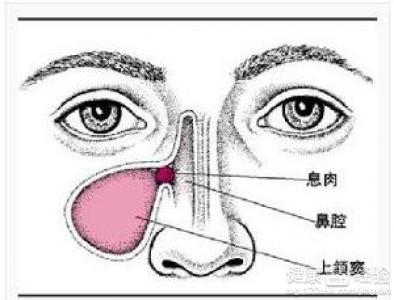 鼻窦炎患者隆哪種鼻子最佳效果好