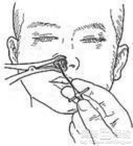 關於鼻窦炎的一些預防措施
