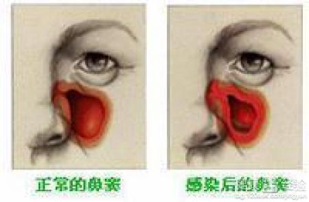 手術治療能根治鼻窦炎嗎？