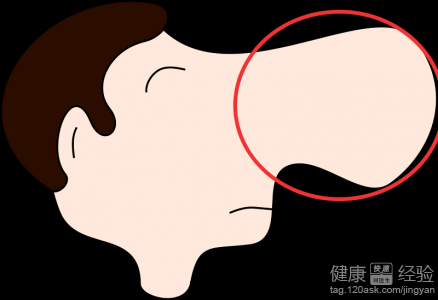 鼻息肉的概述、病因臨床表現