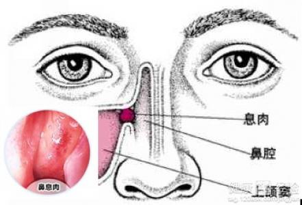 做鼻息肉切割手術需要注意什麼
