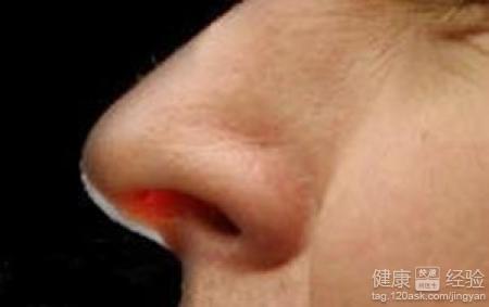 鼻息肉會不會惡化