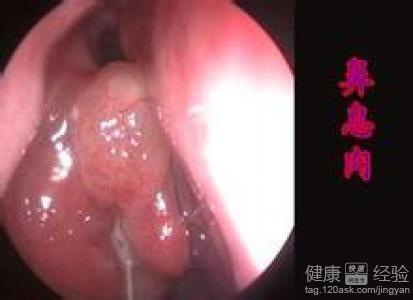 鼻息肉引起了慢性咽炎怎樣治療好