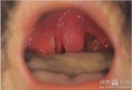 慢性咽喉炎會引發其它疾病嗎