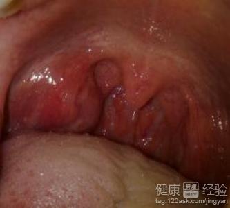 喉嚨發炎要注意什麼？