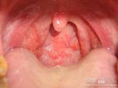 引起急性咽炎的因素有哪些？在家中怎麼護理