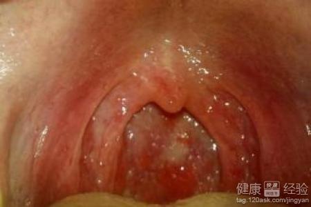 嗓子有白痰，咽部癢的難受怎麼辦？