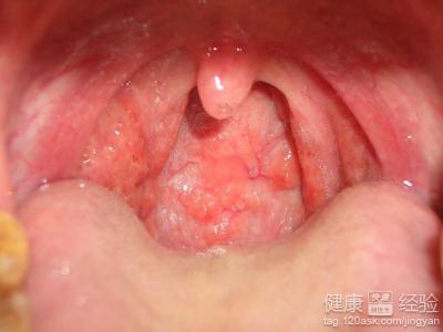 咽喉炎應該怎麼治療呢？