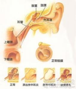 中耳炎治療最佳方法