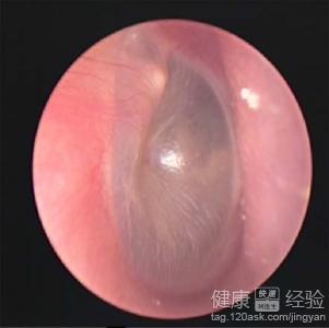 外傷性鼓膜穿孔會引發中耳炎嗎