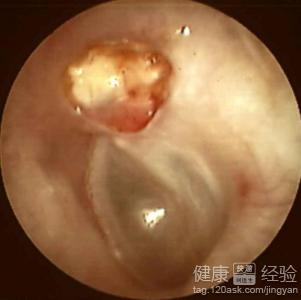 中耳炎可以挖耳朵嗎