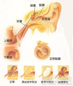 中耳炎血象高嗎