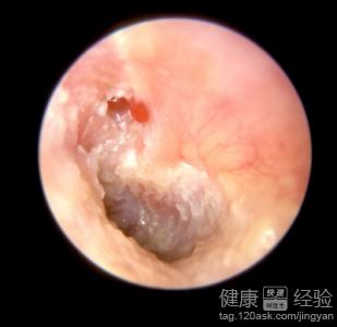 中耳炎膽脂瘤後果嚴重嗎