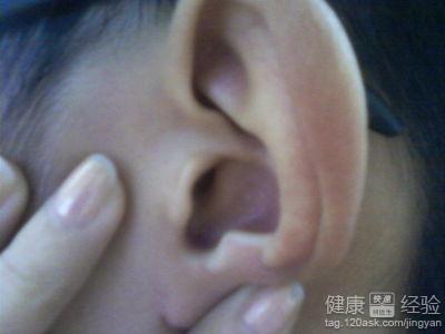中耳炎是如何引起的？
