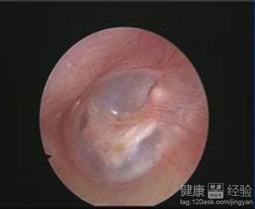 中耳炎有什麼偏方治療嗎