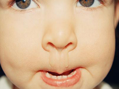 小兒鼻炎的症狀有什麼呢