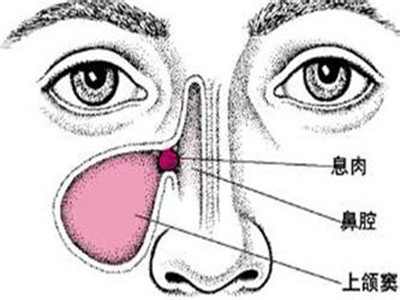 鼻部按摩巧治過敏性鼻炎