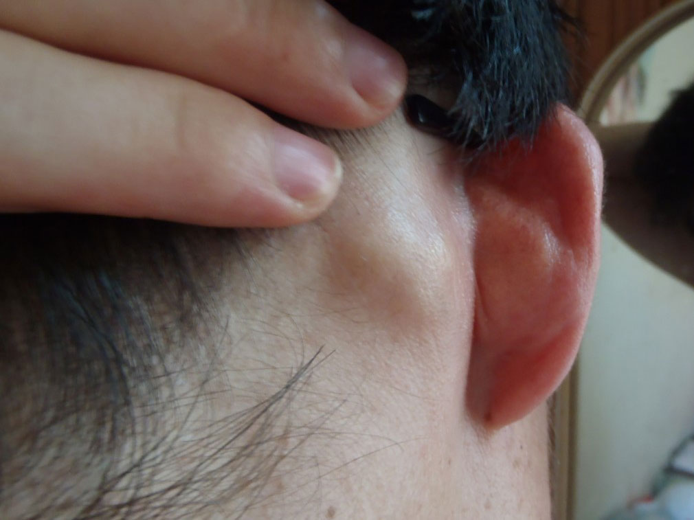 耳後長膿包的原因及護理方法