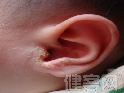 外耳道炎護理需要注意哪些問題