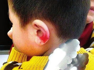 兒童耳外傷如何治療呢
