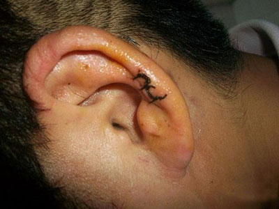 耳外傷後能治療嗎