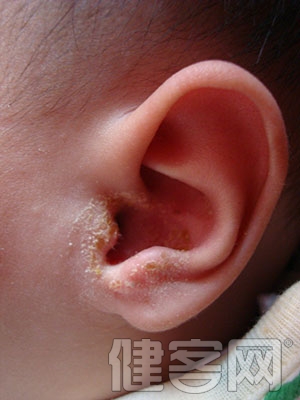 兒童感冒後易得中耳炎？中耳炎如何治療好