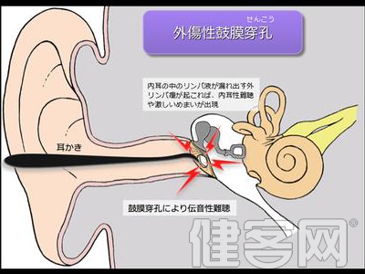 兒童外耳道耵聍分泌多導致耵聍栓塞怎麼辦？