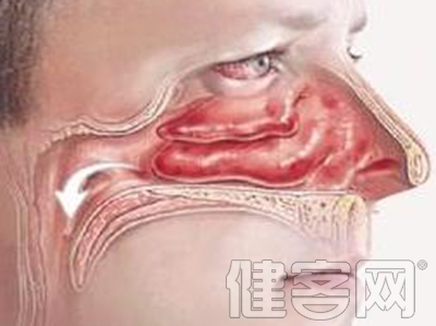 鼻窦炎的發作症狀和治療方法