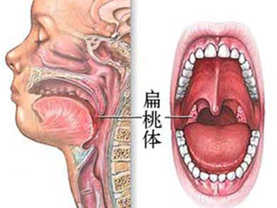 喉狹窄患者術後護理方法