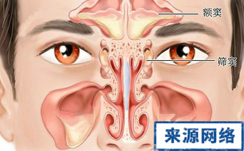 什麼是鼻窦炎 鼻窦炎的症狀 鼻窦炎怎麼治療
