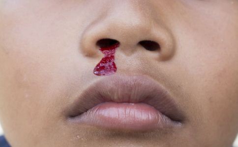 鼻出血怎麼辦 鼻出血如何急救 鼻出血吃什麼