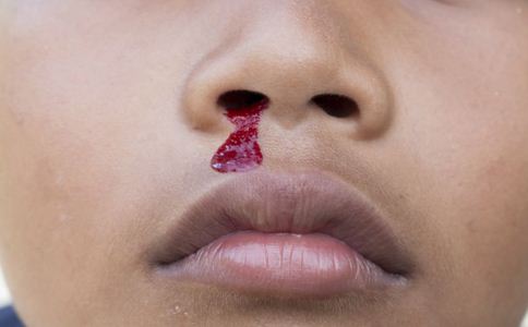 鼻出血怎麼護理 鼻出血怎麼預防 鼻出血怎麼止血