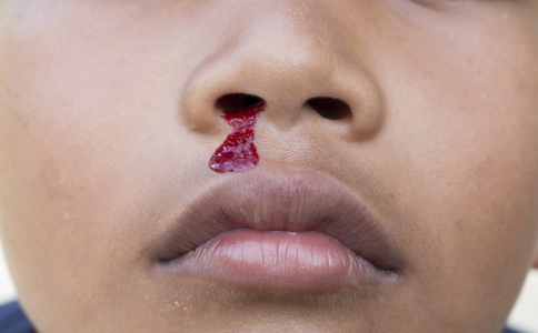 小孩流鼻血的原因 小孩流鼻血如何處理 流鼻血的緊急處理方法