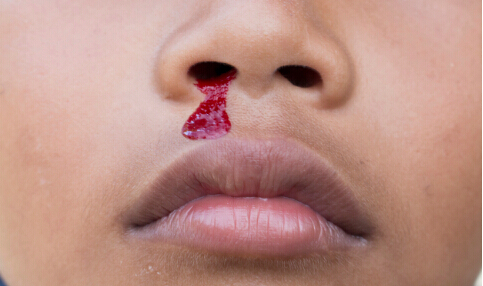 小孩鼻出血 鼻出血怎麼治 如何治療鼻出血