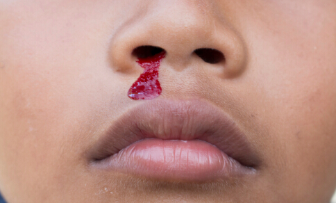 鼻出血的注意事項 鼻出血的原因 鼻出血怎麼辦