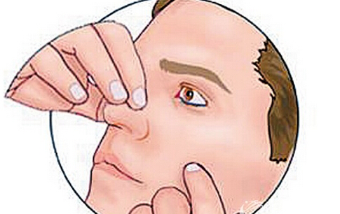 鼻出血怎麼辦 如何處理鼻出血 怎麼處理鼻出血