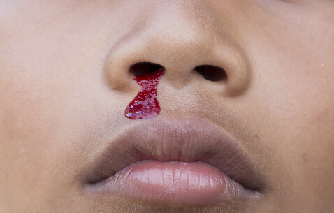 鼻出血的常見原因 夏天流鼻血的原因 夏天流鼻血的治療