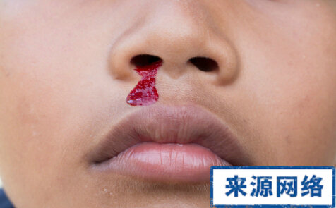 小兒鼻子出血怎麼辦 什麼是小兒鼻子出血 鼻出血怎麼止血