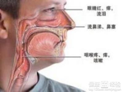 過敏鼻炎的症狀有哪些症狀