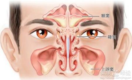 鼻窦炎有頭暈這個症狀嗎