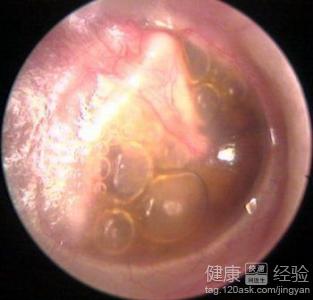 非化膿性中耳炎會自愈嗎