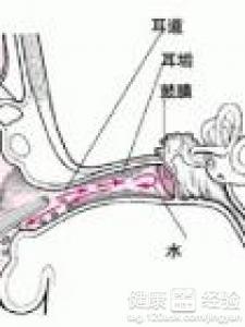 中耳炎如何家庭護理