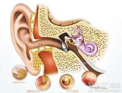 慢性中耳炎飲食5大注意事項