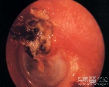 引起慢性化膿性中耳炎的原因是什麼