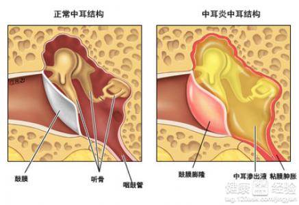 中耳炎的症狀有哪些呢